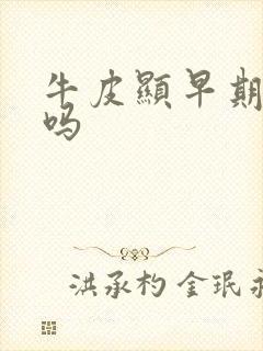 牛皮显早期能治吗