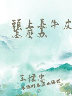 头上长牛皮有癣怎么办