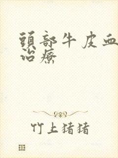 头部牛皮血癣的治疗