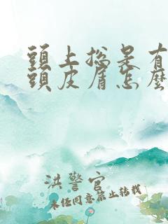 头上总是有很多头皮屑怎么回事