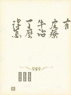 得了牛皮有癣该怎么治疗