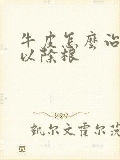 牛皮怎么治疗可以除根