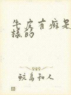 牛皮有癣是怎么样的