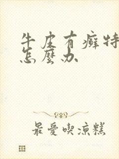 牛皮有癣特别痒怎么办