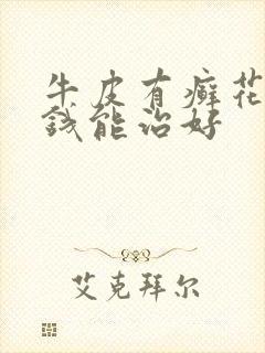 牛皮有癣花多少钱能治好