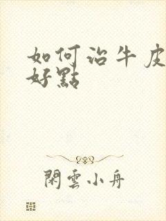 如何治牛皮有癣好点