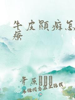 牛皮显癣怎么治疗