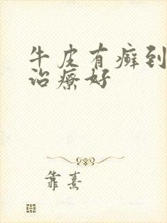 牛皮有癣到哪里治疗好