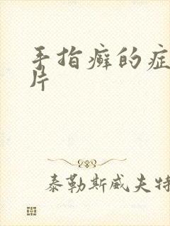 手指癣的症状图片