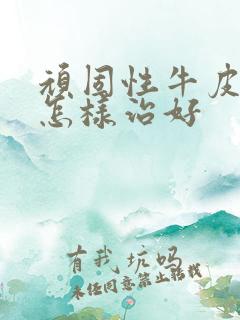 顽固性牛皮有癣怎样治好