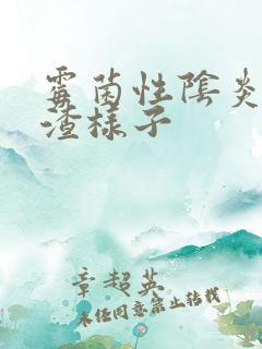 霉菌性阴炎豆腐渣样子