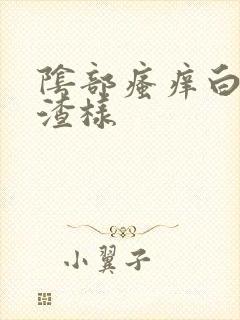 阴部瘙痒白带豆渣样