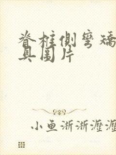 脊椎侧弯矫正支具图片