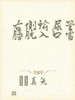 右侧输尿管下段膀胱入口处结石