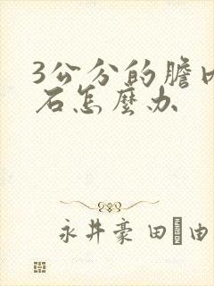 3公分的胆内结石怎么办