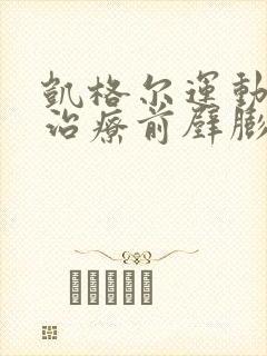 凯格尔运动可以治疗前壁膨出吗