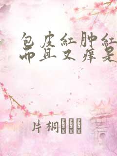 包皮红肿红肿的而且又痒是怎么回事