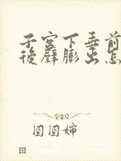 子宫下垂前壁和后壁膨出怎么治疗