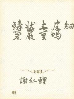 鳞状上皮细胞病变严重吗