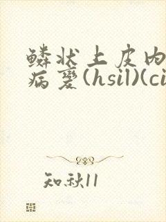 鳞状上皮内高度病变(hsil)(cin2)