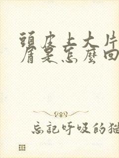 头皮上大片头皮屑是怎么回事