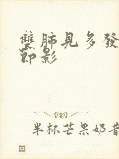 双肺见多发微结节影