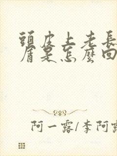 头皮上老长头皮屑是怎么回事