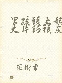 男孩头上起大片大片的头皮屑怎么办