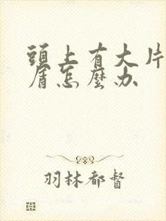 头上有大片头皮屑怎么办