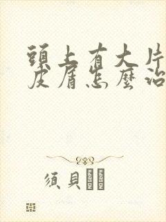 头上有大片的头皮屑怎么治疗封面