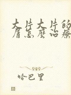 大片大片的头皮屑怎么治疗