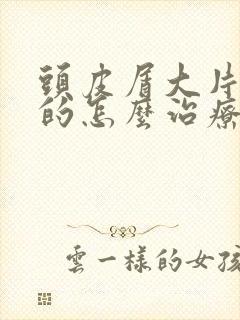 头皮屑大片大片的怎么治疗