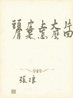 头皮上大片头皮屑是怎么回事