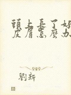 头上长了好多头皮屑怎么办