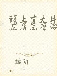 头上有大片的头皮屑怎么治疗