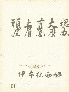 头上有大块的头皮屑怎么办