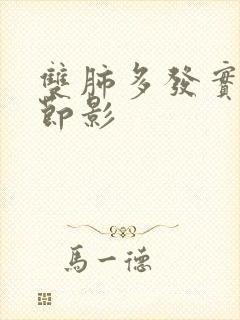 双肺多发实性结节影