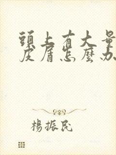 头上有大量的头皮屑怎么办