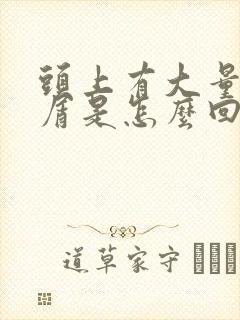 头上有大量头皮屑是怎么回事