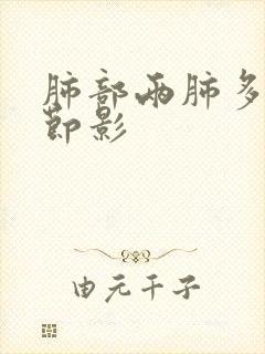 肺部两肺多发结节影