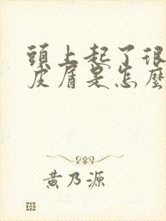 头上起了很多头皮屑是怎么回事