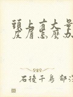 头上有大量的头皮屑怎么办