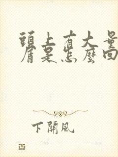 头上有大量头皮屑是怎么回事