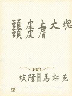 头皮上大块白色头皮屑