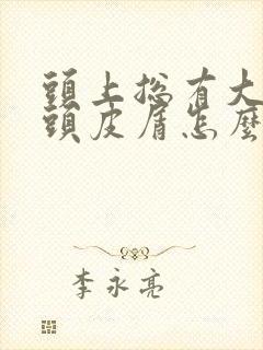 头上总有大块的头皮屑怎么回事