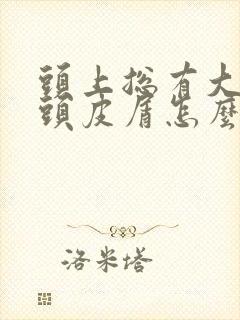 头上总有大块的头皮屑怎么回事