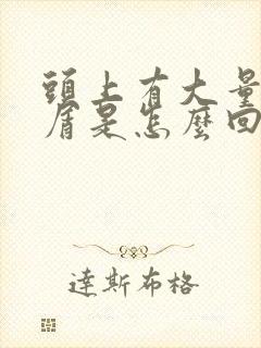 头上有大量头皮屑是怎么回事