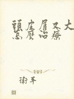 头皮屑又大又多怎么治疗