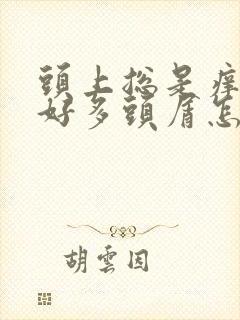 头上总是痒还有好多头屑怎么办啊