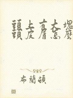 头上有大块白色头皮屑怎么回事